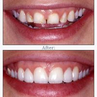 Dental Makeovers: a Beautiful Smile or the Creation of Necessity?