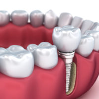 Does Smoking Affect Dental Implants?