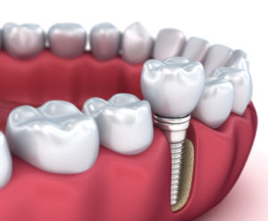 Diagram of tooth restoration