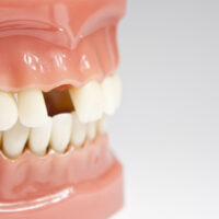 What Are the Consequences of Tooth Loss?
