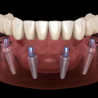 How Many Implants Will I Need for My Implant Dentures?