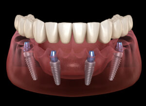 Diagram of implants for prosthesis