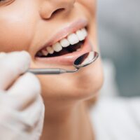 How to Fix a Chipped Tooth