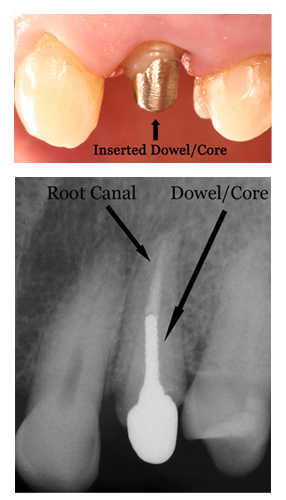 Why Is Post And Core Post And Core Post? – HNPOMS